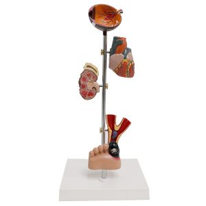 Diabetes Type 2 Model