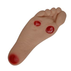 Diabetic Foot Pressure Injury