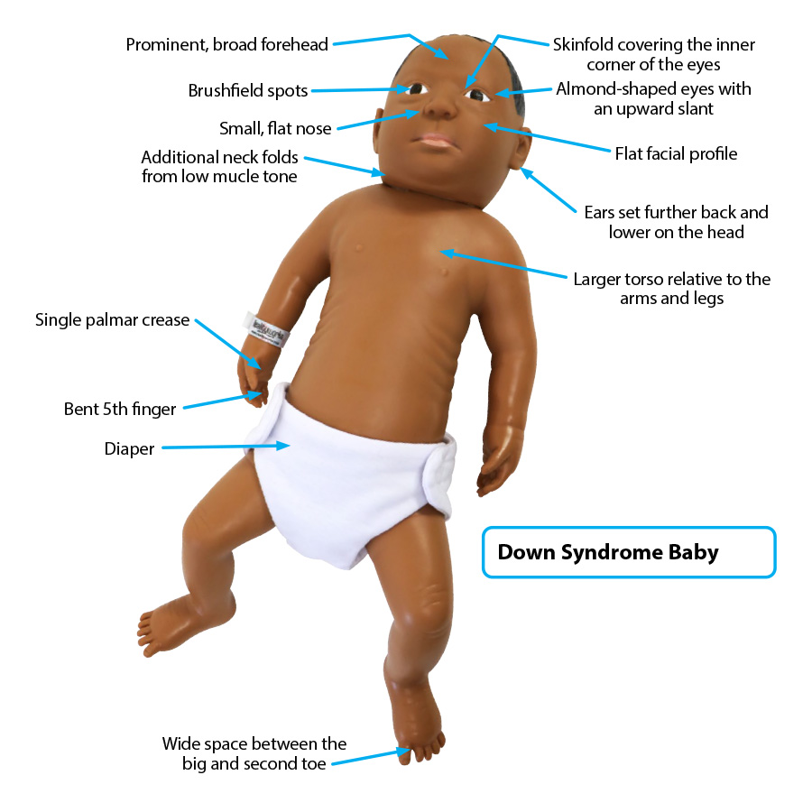 Down Syndrome Video Anatomy WTQM Down Syndrome Video Anatomy WTQM