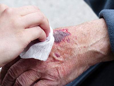 Person treating injury on older adult's hand