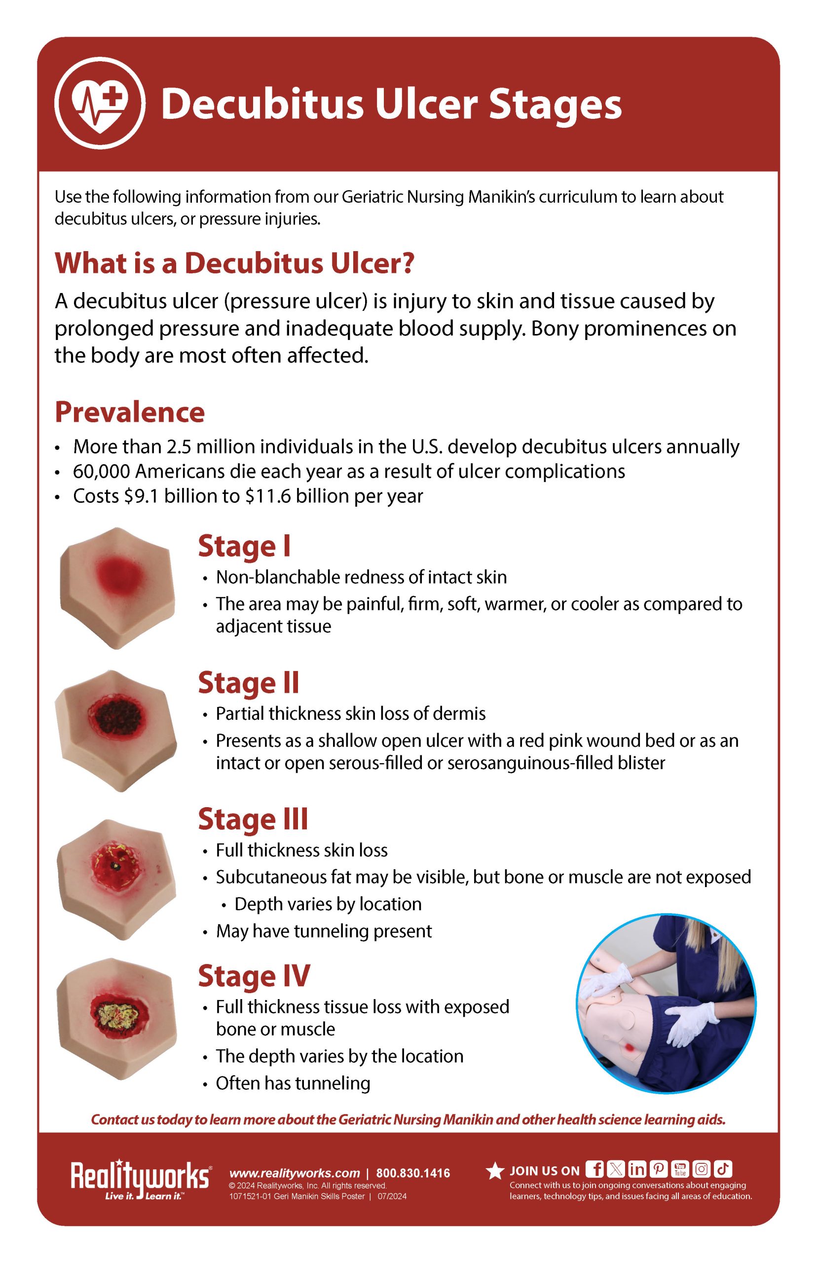 Decubitus Ulcer Stages Skills Poster